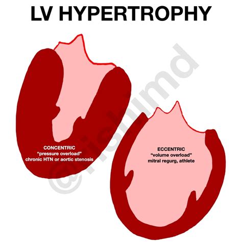 eccentric hypertrophy vs concentric hypertrophy.